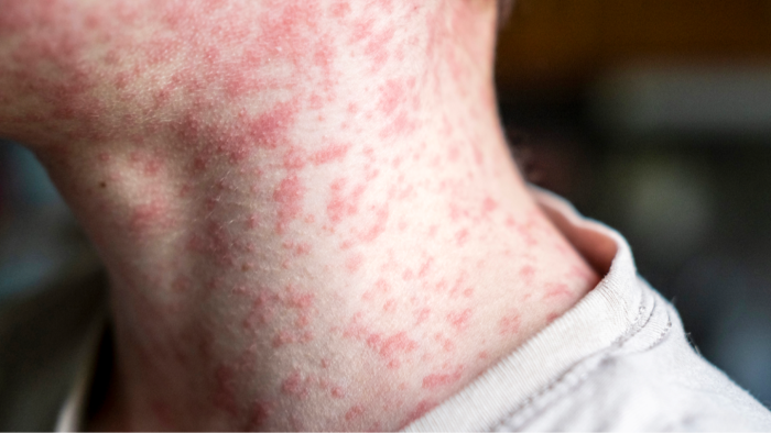 Map and data dashboard highlighting South Carolina measles outbreak, vaccination status breakdown.