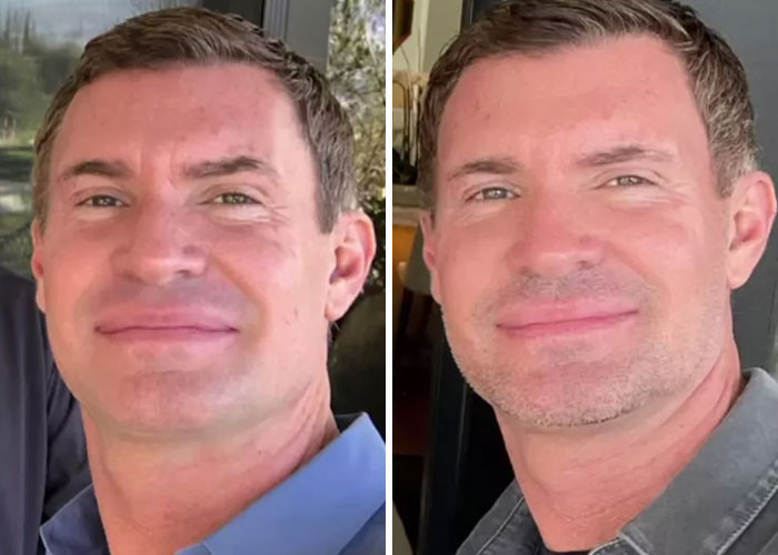 Jeff Lewis - Eyelid surgery