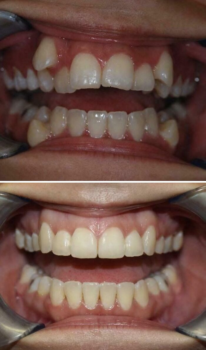 "My Teeth, Before And After Braces"