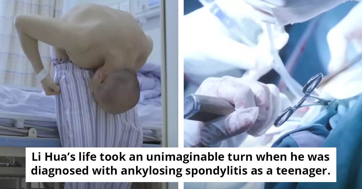 After 28 Years of Being Bent, The 'Folded Man' Receives Life-Changing Surgery
