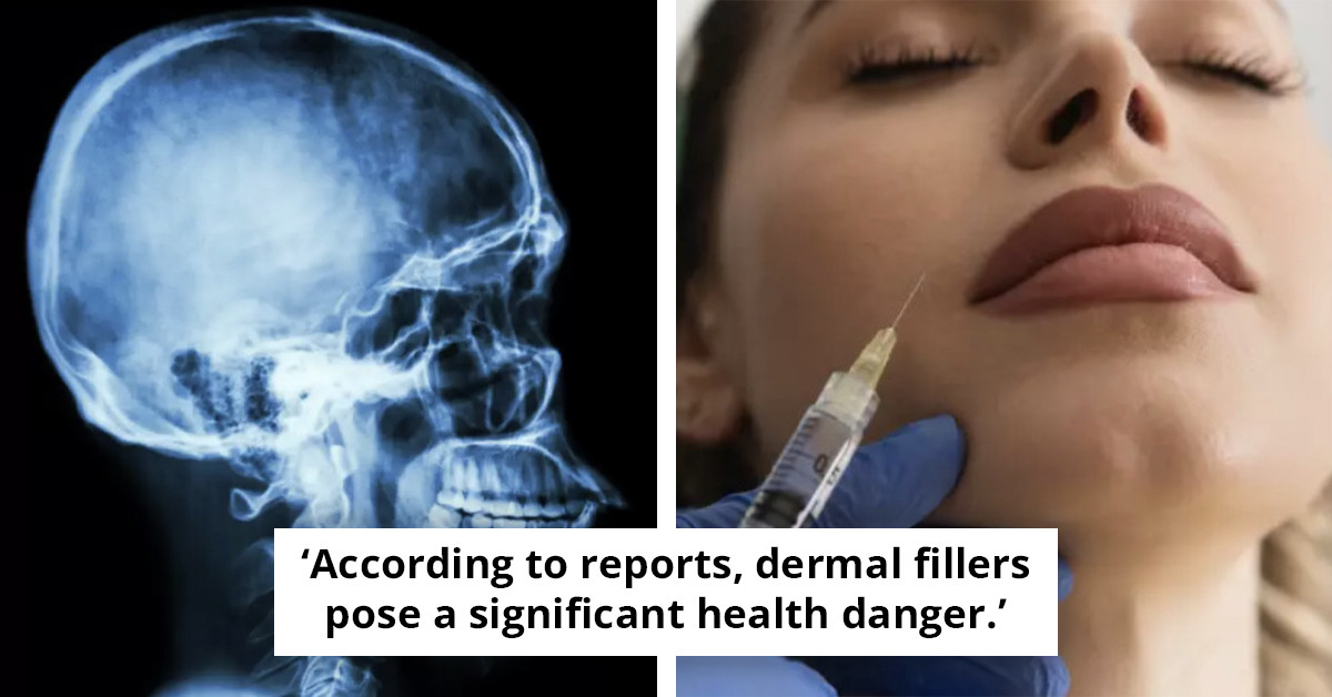 Scan Show Hidden Dangers Of Facial Fillers For Anyone Receiving Injection For Cosmetic Purposes